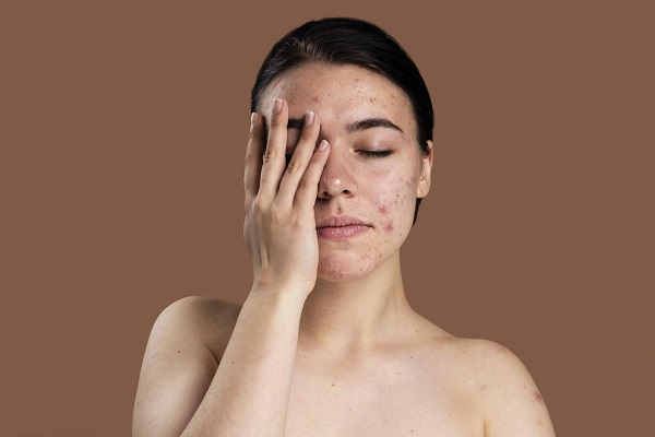 4 dicas de dermatologia para pele oleosa: descubra