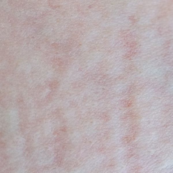 dermatite atópica no inverno
