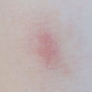 dermatite atópica no inverno