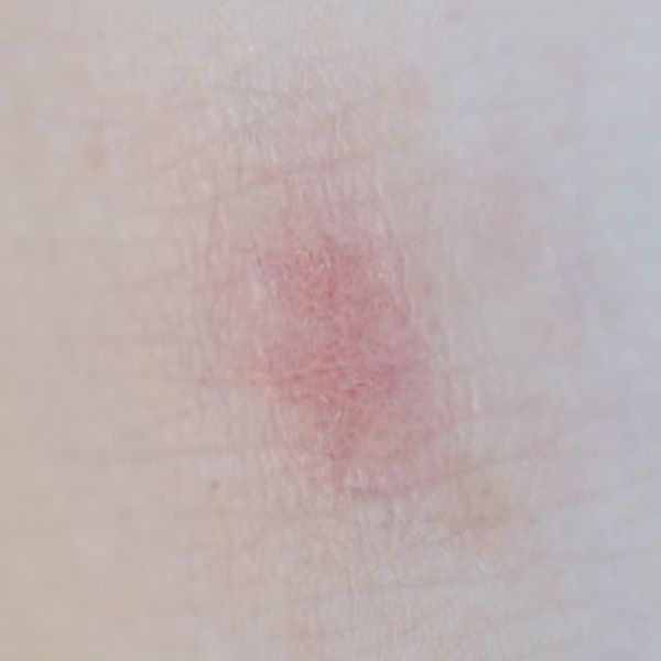 dermatite atópica no inverno